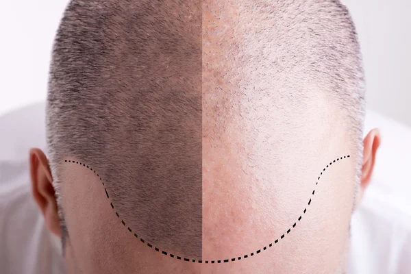 Hair Transplantation